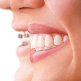 Invisalign_vs_braces