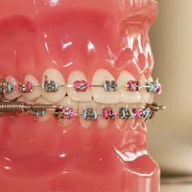 braces_close