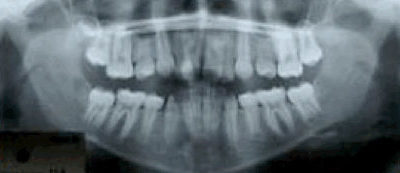 panoramic_xray