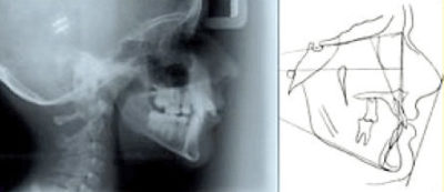 side_lateral_head_xray